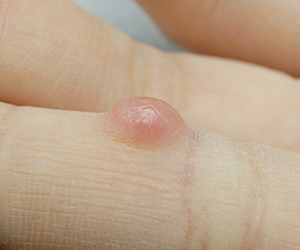 皮膚腫瘍（できもの）の種類：後天性指趾被角線維腫（こうてんせいししひかくせんいしゅ）