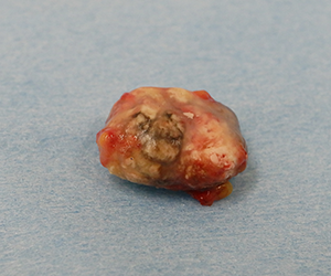 皮膚腫瘍（できもの）の種類：石灰化上皮腫（毛母腫）の症例2
