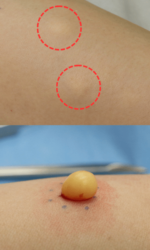 皮膚腫瘍（できもの）の種類：多発性脂腺嚢腫