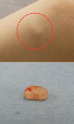 皮膚腫瘍（できもの）の種類：血管平滑筋腫