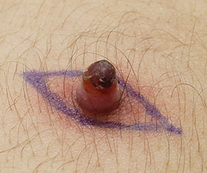 皮膚腫瘍（できもの）の種類：毛細血管拡張性肉芽腫（もうさいけっかんかくちょうせいにくげしゅ：化膿性肉芽腫）の症例1