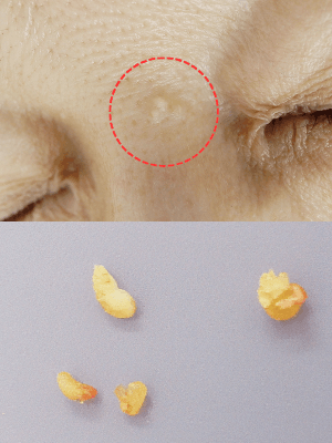 皮膚腫瘍（できもの）の種類：稗粒腫の症例1