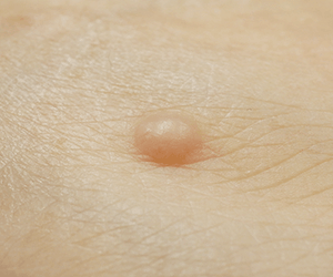 皮膚腫瘍(できもの)の種類:神経線維腫(しんけいせんいしゅ)