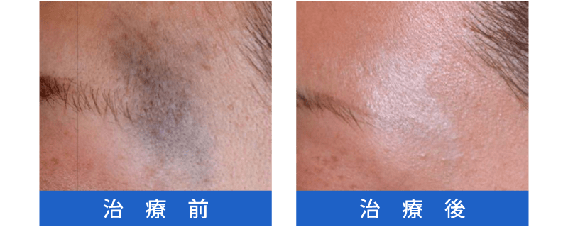 Qスイッチレーザー治療の症例3