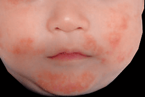 アトピー性皮膚炎の症状：乳児期（2歳未満）