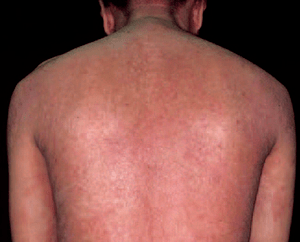 アトピー性皮膚炎の症状：思春期・成人期（13歳以上）