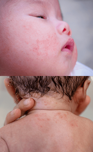 乳児湿疹の症状