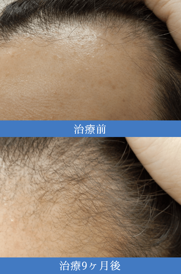 AGA（男性型脱毛症）治療の症例3