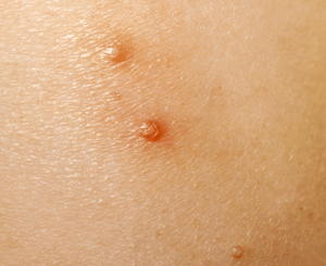 伝染性軟属腫患者の見通し