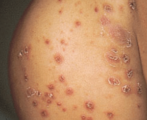 あせも（汗疹）の合併症：伝染性膿痂疹（とびひ）の症状
