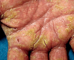 手湿疹の症状：角化型手湿疹