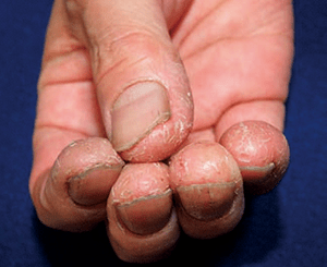 手湿疹の症状：進行性指掌角皮症