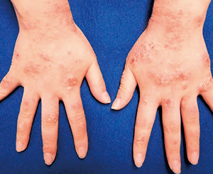 手湿疹の症状：貨幣状型手湿疹