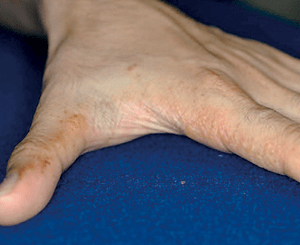 手湿疹の症状：再発性水疱型（汗疱型）手湿疹