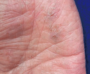 手湿疹の症状：乾燥・亀裂型手湿疹