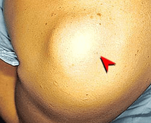 皮膚腫瘍（できもの）の種類：肩にできた脂肪腫の症例