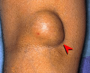 粉瘤の症状：脂肪腫と粉瘤の違い