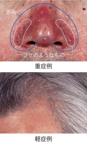 顔の脂漏性皮膚炎の症例