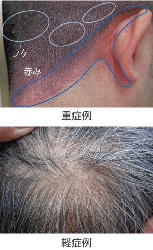 頭部の脂漏性皮膚炎の症例