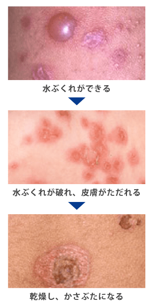 水疱性膿痂疹（すいほうせいのうかしん）の症状
