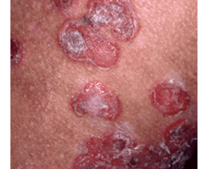痂皮性膿痂疹（かひせいのうかしん）の症状