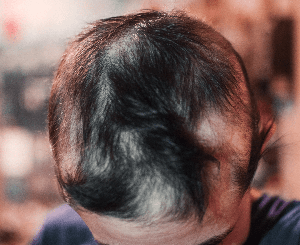 円形脱毛症の症状：多発型円形脱毛症