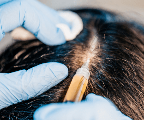 円形脱毛症の治療：ステロイド局所注射