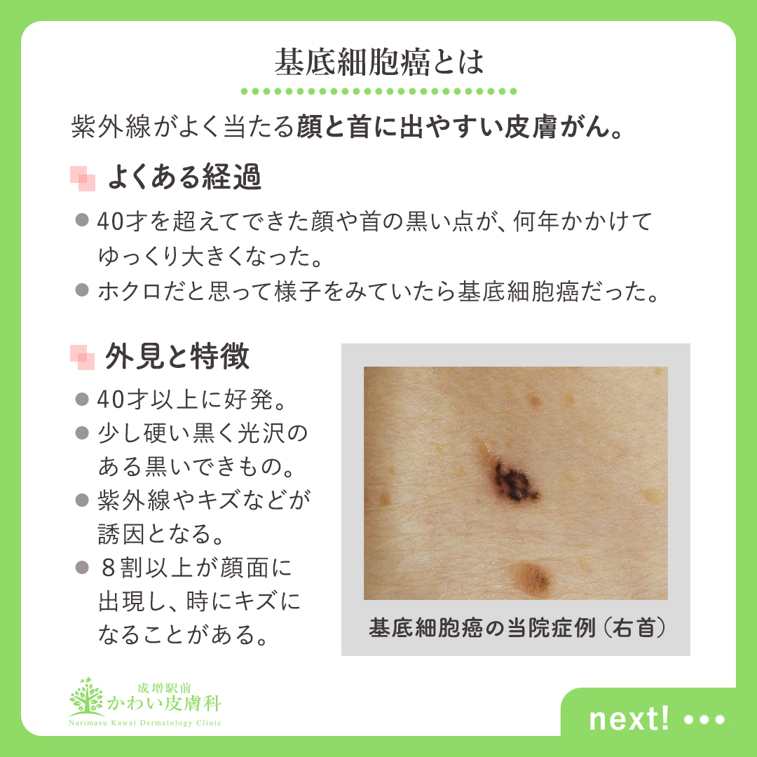 それって本当にホクロですか？皮膚がんシリーズ2：基底細胞癌 板橋区成増駅前かわい皮膚科