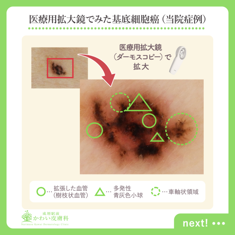 それって本当にホクロですか？皮膚がんシリーズ2：基底細胞癌 板橋区成増駅前かわい皮膚科