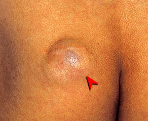 臀部にできた粉瘤（ふんりゅう・アテローム）の症状