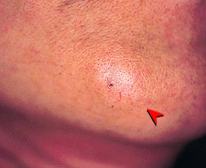 アゴにできた粉瘤（ふんりゅう・アテローム）の症状