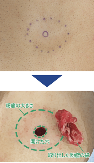 粉瘤（ふんりゅう・アテローム）の治療「くり抜き法」症例写真2