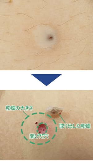 粉瘤（ふんりゅう・アテローム）の治療「くり抜き法」症例写真1