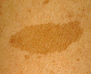 扁平母斑（へんぺいぼはん：茶あざ）の症状