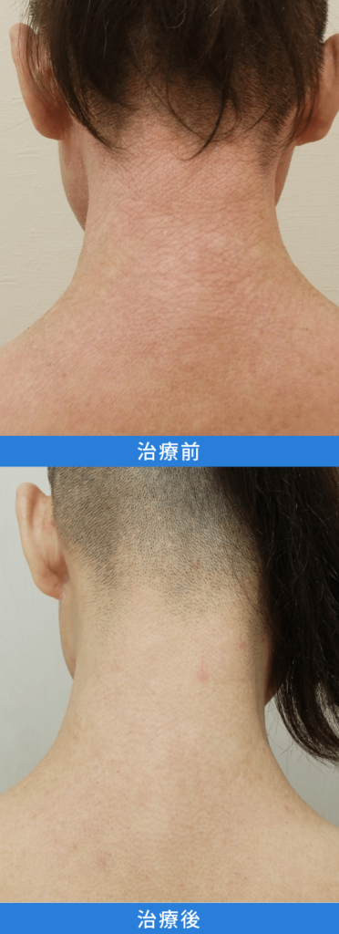 アトピー性皮膚炎治療 デュピクセント症例写真：頭皮・首