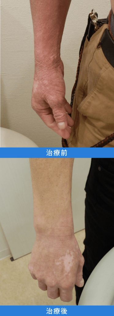 アトピー性皮膚炎治療 デュピクセント症例写真：右腕