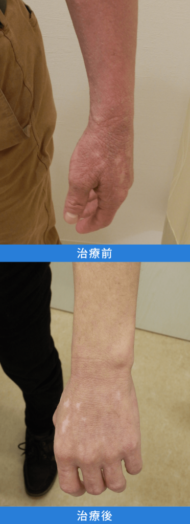 アトピー性皮膚炎治療 デュピクセント症例写真：左腕