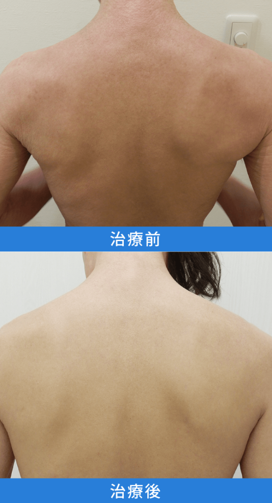アトピー性皮膚炎治療 デュピクセント症例写真：背中