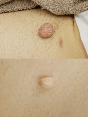 皮膚腫瘍（できもの：ほくろ・イボ・粉瘤）の治療 - 成増駅前かわい皮膚科
