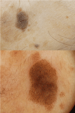 皮膚腫瘍（できもの）の種類：脂漏性角化症