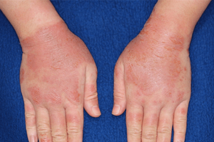 接触皮膚炎（かぶれ）：ゴム手袋による刺激性接触皮膚炎の症状
