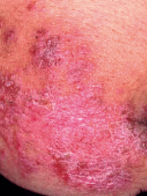 接触皮膚炎（かぶれ）：金属アレルギーによるアレルギー性接触皮膚炎の症状