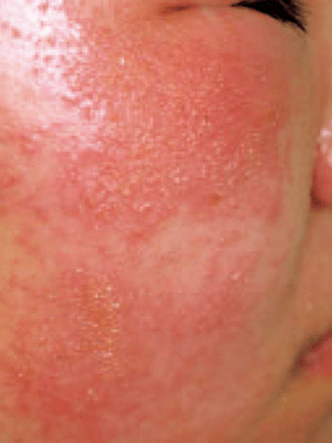 接触皮膚炎（かぶれ）：ウルシ（植物）によるアレルギー性接触皮膚炎の症状