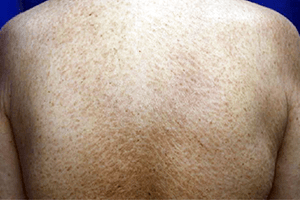 接触皮膚炎（かぶれ）：ニッケルによ全身性金属皮膚炎（全身型金属アレルギー）の症状