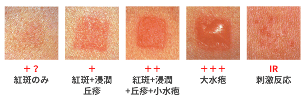 アレルギー性接触皮膚炎の判定基準