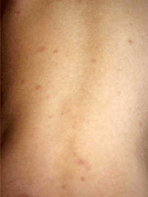 水痘（水ぼうそう）の症状：小児の水痘の症状