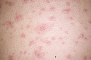 水痘（水ぼうそう）の症状：成人の水痘多発症状