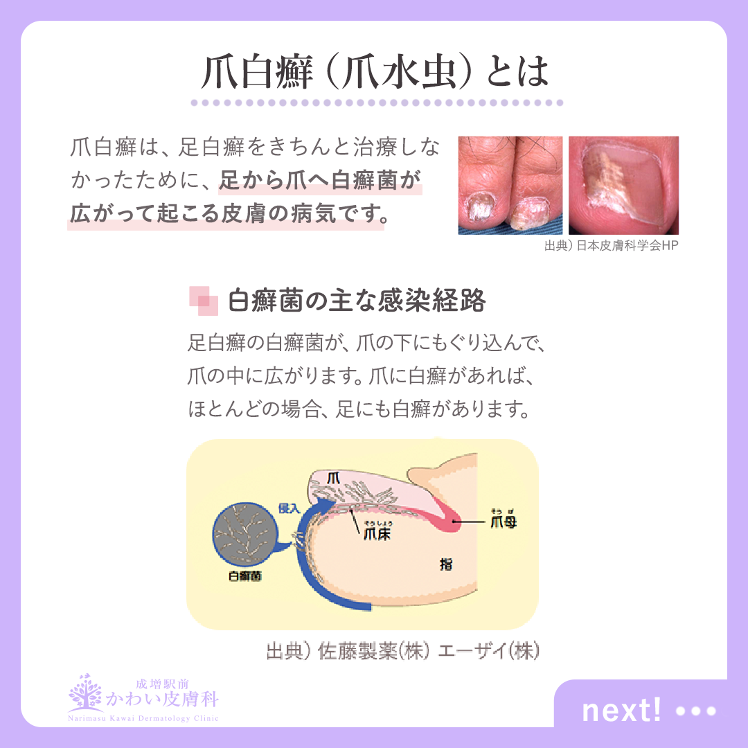 しらくも 治療 | 頭皮 水虫 治し方 – MIZQL