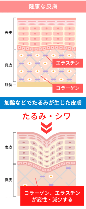 たるみ・シワができる原因