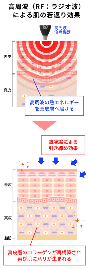 高周波（RF：ラジオ波）による肌の若返り（スキンリジュビネーション）効果